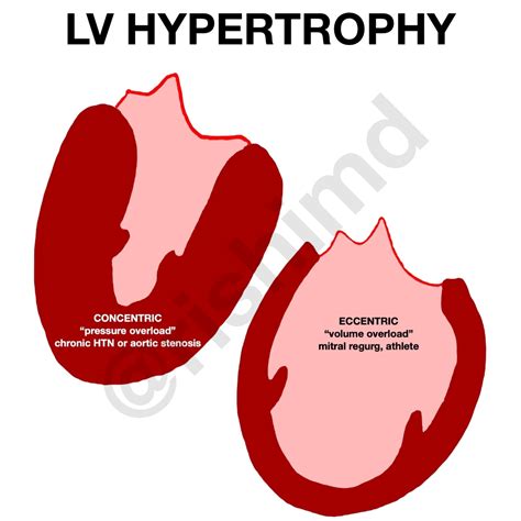 lv concentric hypertrophy|eccentric vs concentric hypertrophy heart.